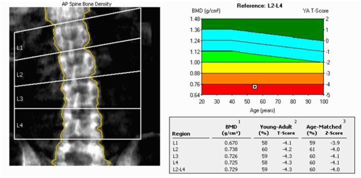 DXA scan of Spine with severe osteoporosis