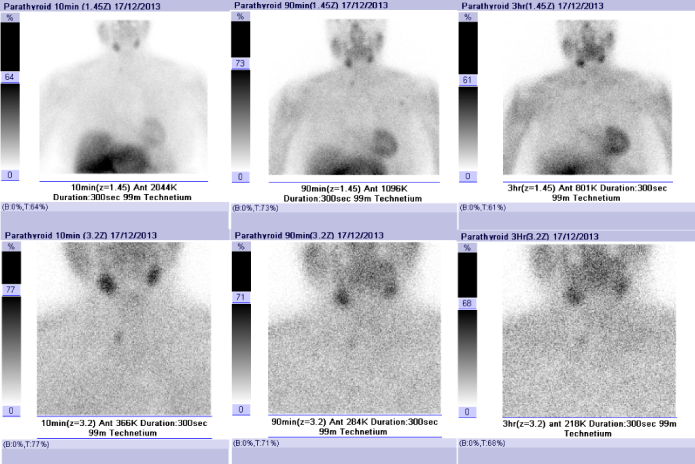 Sestamibi scan showing right sided parathyroid adenoma